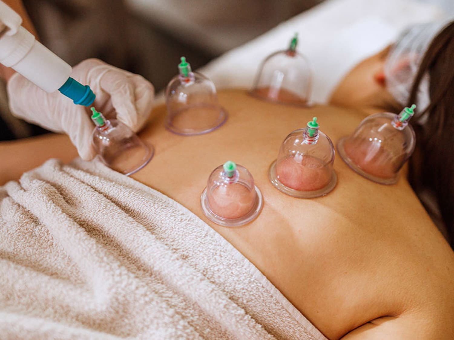 Cupping-Therapy